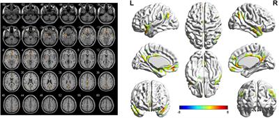 Altered functional connectivity within default mode network after rupture of anterior communicating artery aneurysm